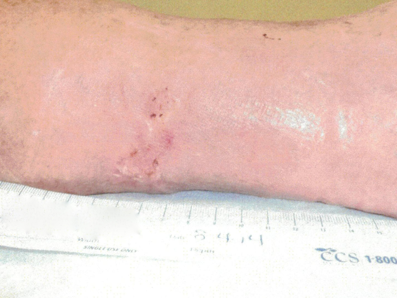 Ulcer Patient 1 After