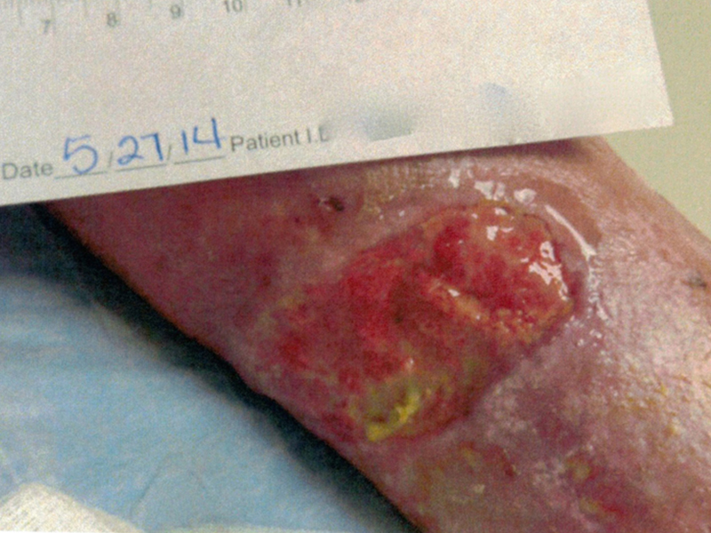 Ulcer Patient 1 Before