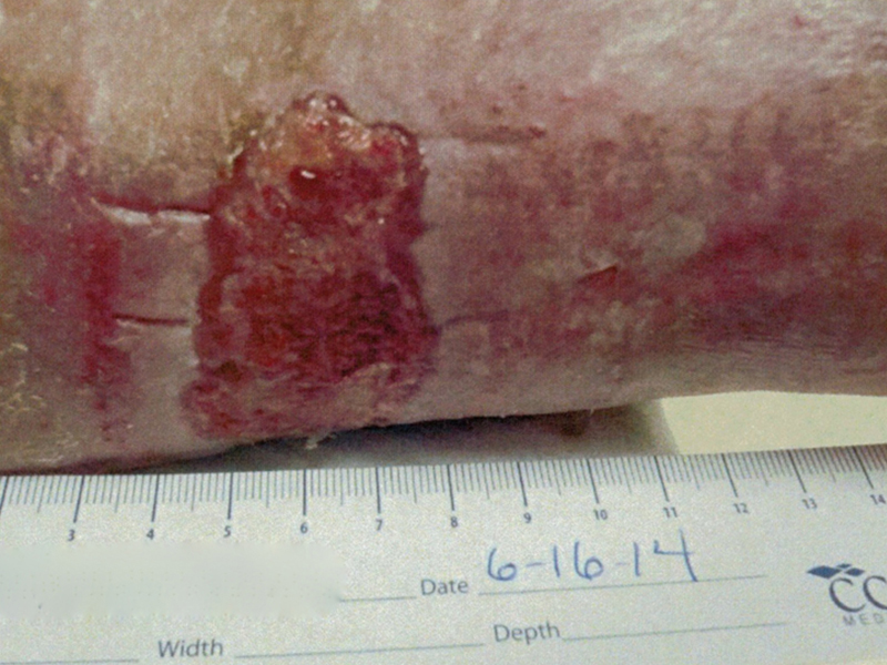 Ulcer Patient 1 During