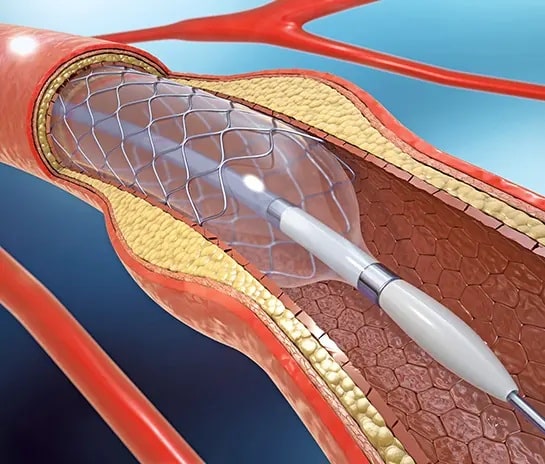 Coronary angioplasty and stenting